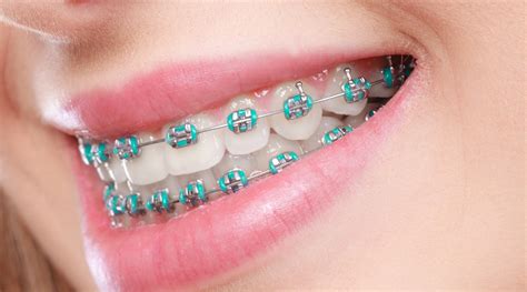 metal bracket dental|dental braces traditional metal.